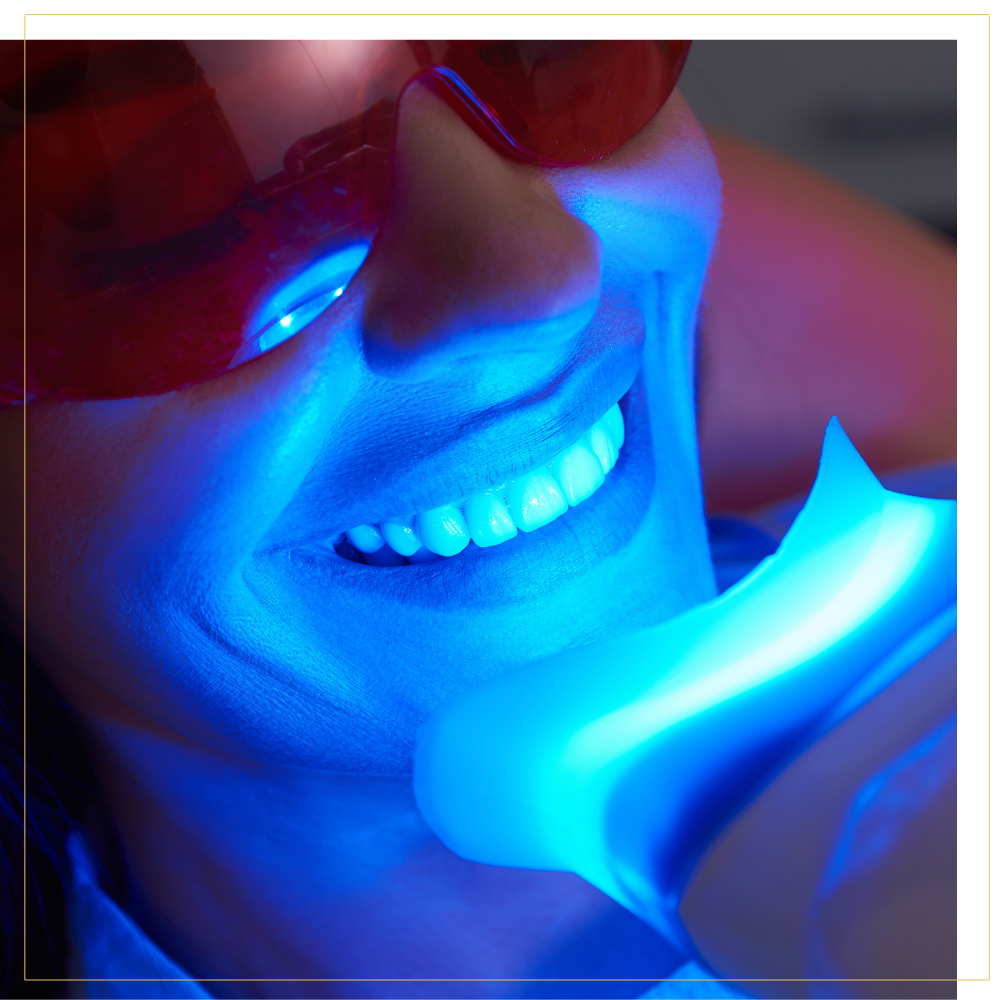 Blanchiment dentaire Le Mirage SPA